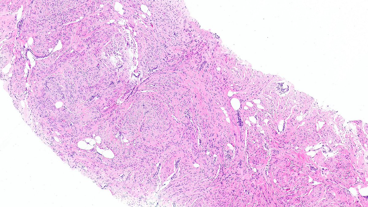 RazaHoda's tweet image. What’s this spindle cell lesion of the breast?

Poll in comments 👇

Answer revealed on Monday 🔮

#PathX #PathTwitter #breastpath