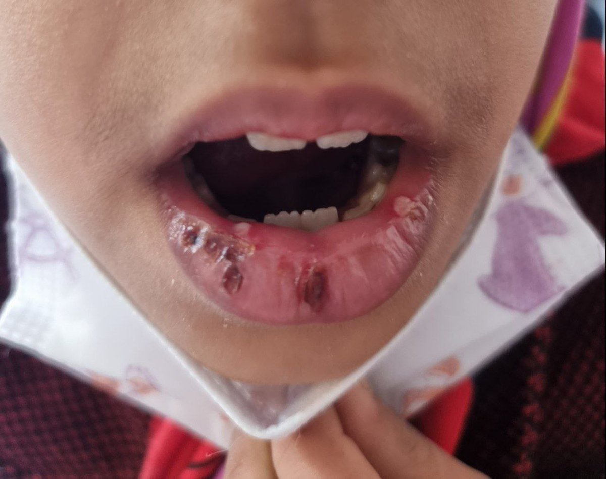 An 8-year-old girl with fever and cough woke up one night and noticed swelling of the lips and the appearance of these lesions in the morning. Examination and ultrasound of the neck revealed multiple reactive lymph nodes.
What is happening?
What type of Pneumonia?