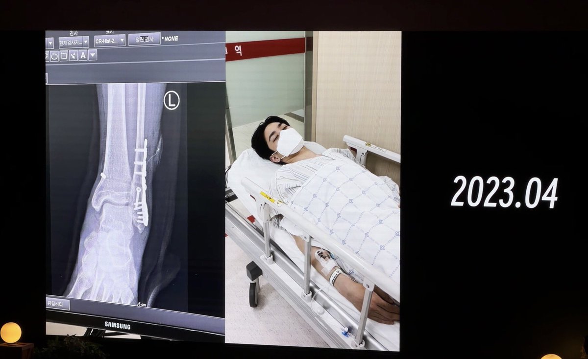drumbrisix's tweet image. 260101 KUN Birthday party

2023.04
This surgery may be the biggest trauma I've ever experienced in my life.

#KUN #쿤 #钱锟 #クン 
#威神V #WayV
#KUN_BDAY_PARTY