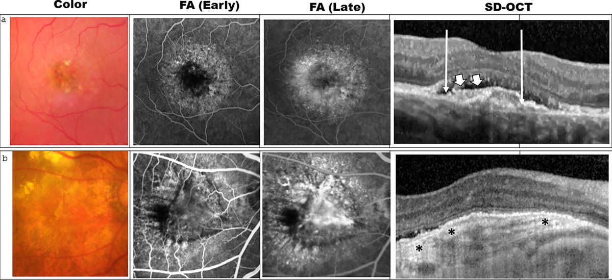 AAOjournal's tweet image. A new study from the International Fibrosis Consensus (IFC) workgroup and members of the International Retinal Imaging Society (IntRIS) aimed at developing a standardized diagnostic workflow establishes a two-step approach using OCT as the primary modality and confirmation with…