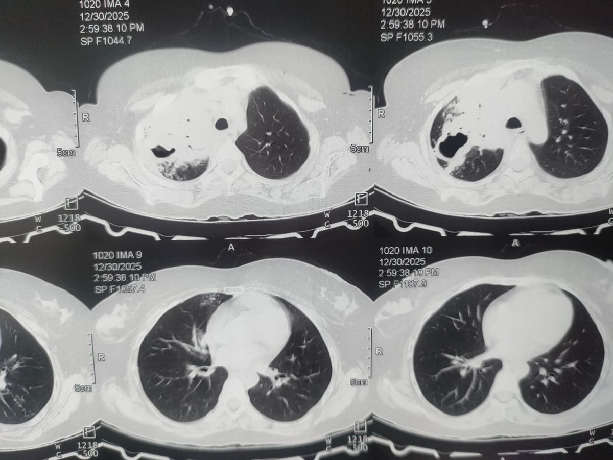 DoctorShiva007's tweet photo. Recently saw a patient with pulmonary TB who was treated multiple times as typhoid only based on a single Widal test. Received repeated injections of ceftriaxone.

Reality
Chest X-ray and CT chest were classical for TB.
Sputum TrueNAAT was negative, yet radiology and clinical picture were convincing.

Widal test is one of the most misleading tests we still use.
False positives are common.
Single report has no diagnostic value.
Leads to wrong diagnosis, antibiotic misuse, delayed TB detection.

In endemic countries like India, TB is a great mimicker.
Diagnosis should be clinical + radiological + microbiological, not shortcut medicine.

Widal should be abandoned, or at least never used in isolation.
Patients suffer when poor tests guide confident decisions.

Medicine is about judgment, not blind reports.