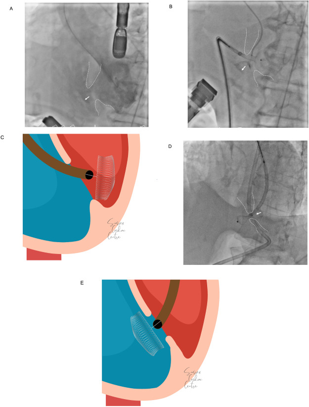 CRMjournal's tweet image. Just accepted in @CRMjournal+@ELS_Cardiology!

Percutaneous transaxillary arterial access for closure of post-infarction #VSD by Siu-Fung Wong et al.

sciencedirect.com/science/articl…