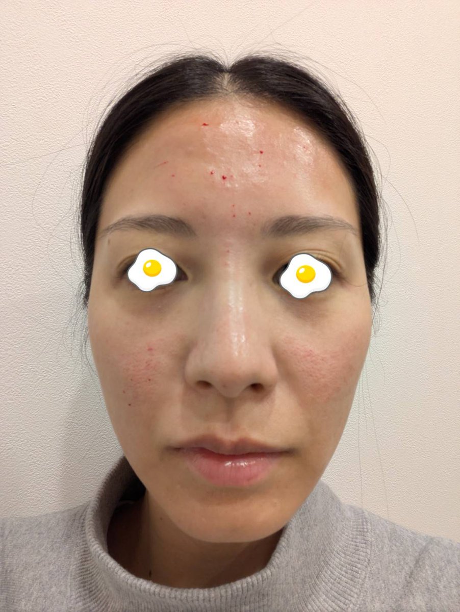 2026年美容医療初めは、毛穴改善目的でジュベルックを額・鼻・頬に💉自分で麻酔を塗るスタイル🏥
カウンセリングめも📝
ゴルゴ線にヒアルロン酸を入れてチークトップを上げることで、ほうれい線との段差をなだらかにする。その後、目の下のくぼみにベビーコラーゲンを入れると、きれいに仕上がる。