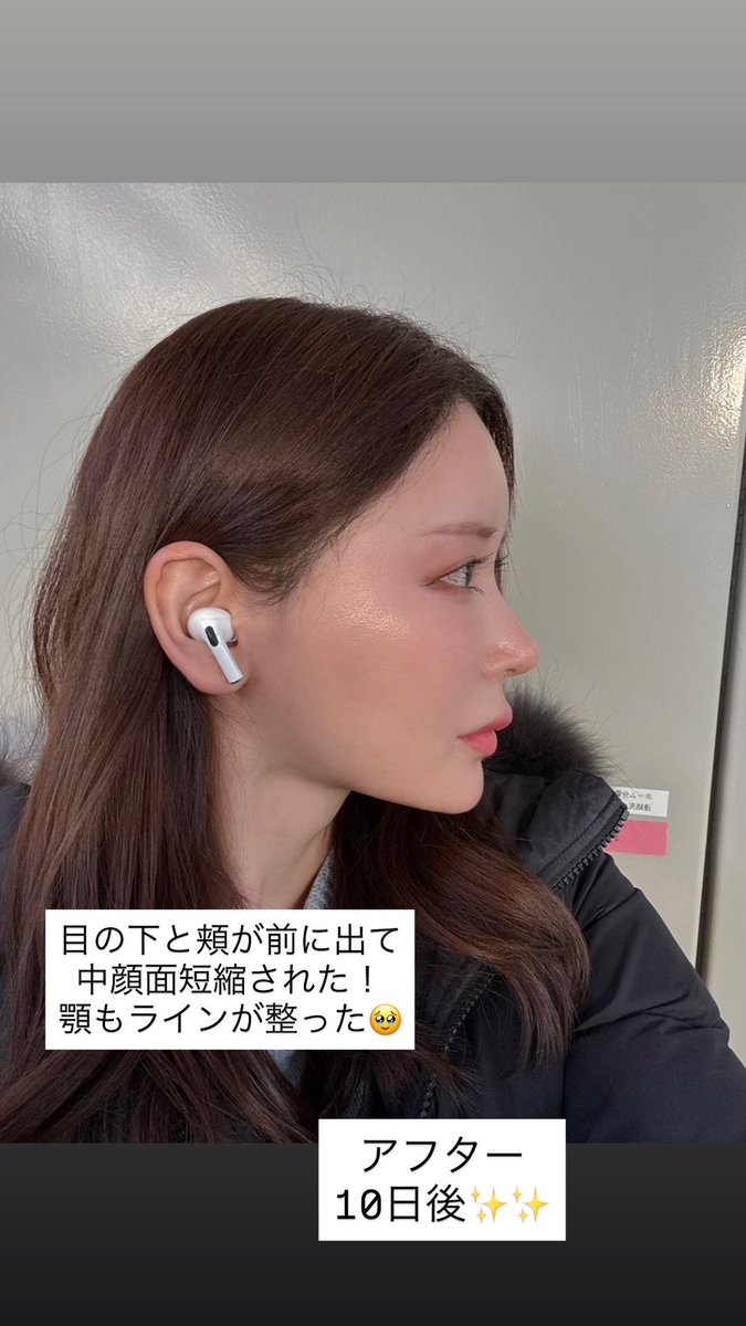 ossan_kunna's tweet photo. 韓国でフィラー受けるなら
ガチで激推ししたいクリニック🏥
何十回もフィラー入れてきた中で、
私はここが一番信用出来ます！！🫶

・顎先フィラー
・目の下の凹み（前頬も繋げるように少し）

局所麻酔なので施術中の痛みは無し✨✨

顎は0.5ccで、
下には出さず、前に出すように入れて貰った🫶
たった0.5ccでフェイスライン爆誕した！
城之内みたいにならずに、ナチュラルな顎✨✨
元々輪郭が綺麗な人みたいで嬉しい👏

目の下のフィラーは、1.1cc！
前頬と繋がるように自然に入れてもらったから、
頬の位置が上がって中顔面短く見える！⤴️

目の下のフィラーは難しいので
やってるクリニックがほとんどないです😿
ここの代表院長は目の下の凹みフィラーが得意で有名なので安心して任せられます🥹🫶

私は2025年に3回も代表院長にフィラー入れて貰ってる（笑）
他の先生にフィラーしてもらうより、絶対ここが良いので😭💖
今までフィラーは日本でも韓国でも何回も大失敗してるから、信用出来る先生が良い😿✨✨

beauty&young
ビューティーアンドヤングクリニック
新沙駅すぐ
@beautynyoung_jp 

#皮膚科 #アンチエイジング #����り #プチ整形 #韓国 #渡韓美容 #上手い #フィラー #ヒアルロン酸 #目の下 #凹み #頬フィラー #頬コケ #顎フィラー #シンサ #新沙  #美容外科 #ナチュラル #PR