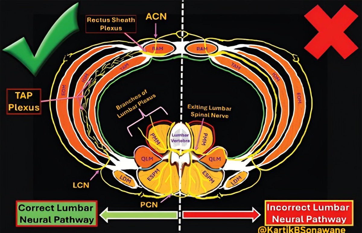 KartikBSonawane's tweet photo. 🚀 “Fascial Highways, Not Magic Shots” - Take-Home Messages from Decoding QL Blocks
#RegionalAnesthesia #PainMedicine #UltrasoundGuided #FascialPlaneBlocks #QuadratusLumborumBlock #QLB #ThoracolumbarFascia #TLF #TransmuscularQLB #AnteriorQLB #PosteriorQLB #TAPBlock #AbdominalWallAnalgesia
🧭 QLB is TAP’s evolved cousin:
TAP mainly stays in the TAP plane (somatic abdominal wall), while QLB tries to “borrow” deeper fascial continuities to extend coverage.
🕸️ The thoracolumbar fascia (TLF) is the real engine:
QLB success is governed more by fascial architecture than by “which nerve you think you’re blocking.”
🛣️ Anterior TLF = the main ‘fascial highway’:
It connects laterally to transversalis fascia, medially to psoas fascia, and cranially toward endothoracic fascia- explaining why deeper approaches can sometimes go broader (and occasionally visceral).
🎯 If you want broader + more predictable spread, think “anterior/transmuscular”:
The review highlights why anterior approaches more consistently access paravertebral/lumbar plexus corridors than superficial/lateral techniques.
🧱 Lateral & posterior QLB = reliable somatic analgesia (mostly):
Great for flank/lateral wall pain, but don’t expect consistent visceral cover.
🔬 T12→L1 transition is the clinical ‘game-changer’:
At/after L1, the psoas is more evident and the lumbar plexus starts forming- helping explain why anterior QLB at/below L1 can be more extensive.
🧠 Stop teaching the wrong nerve story:
Lumbar plexus nerves don’t just “enter the TAP.” That common schematic error leads to unrealistic expectations from TAP/lateral QLB.
🧩 Anterior QLB isn’t one block-it’s multiple sub-compartments: Small needle-tip shifts can redirect spread cranial/medial/posterior and change what you get clinically.
🔼 Want upper abdominal + possible visceral component?
Aim for the plane that favors cranial tracking along endothoracic continuity (subcostal/anterior variants are built for this logic).
🧷 Technique selection should be indication-driven:
Lateral/posterior for somatic flank; anterior/CPPB when you need deeper/lumbar plexus or broader abdominal–pelvic coverage.
⚠️ Safety isn’t optional - anterior is closer to neuraxis/lumbar plexus:
Higher risk of unintended neuraxial spread if volume/plane is wrong; lateral variants risk peritoneal/retroperitoneal breach, so dynamic US, incremental injection, and vigilance matter.
📌 Bottom line:
QLB outcomes vary because anatomy + fascial compliance + injection dynamics vary - so reproducibility comes from precise plane selection, not from “QLB label” alone.
Read in details:
Indian Journal of Anaesthesia https://t.co/CHRCwW6HR0