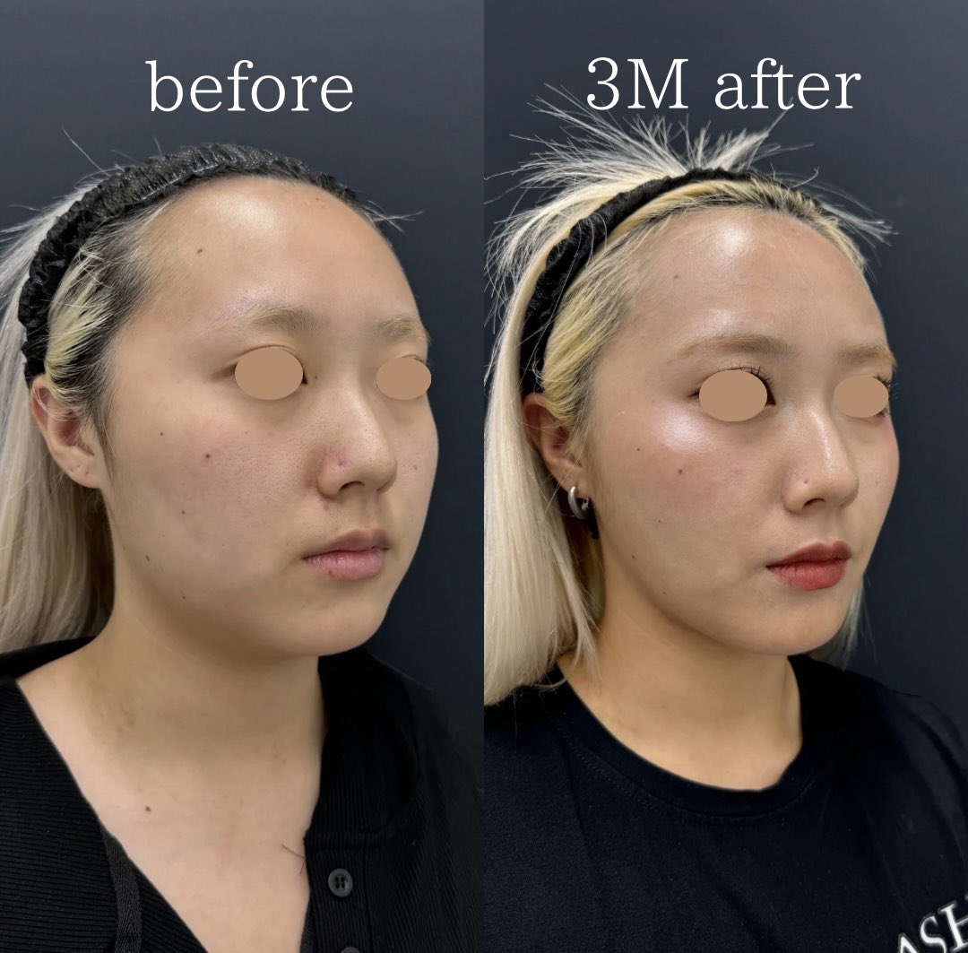 きゅ整形垢 美容外科医もわからない🤦 天才すぎる垢抜け美女。 整形顔になって