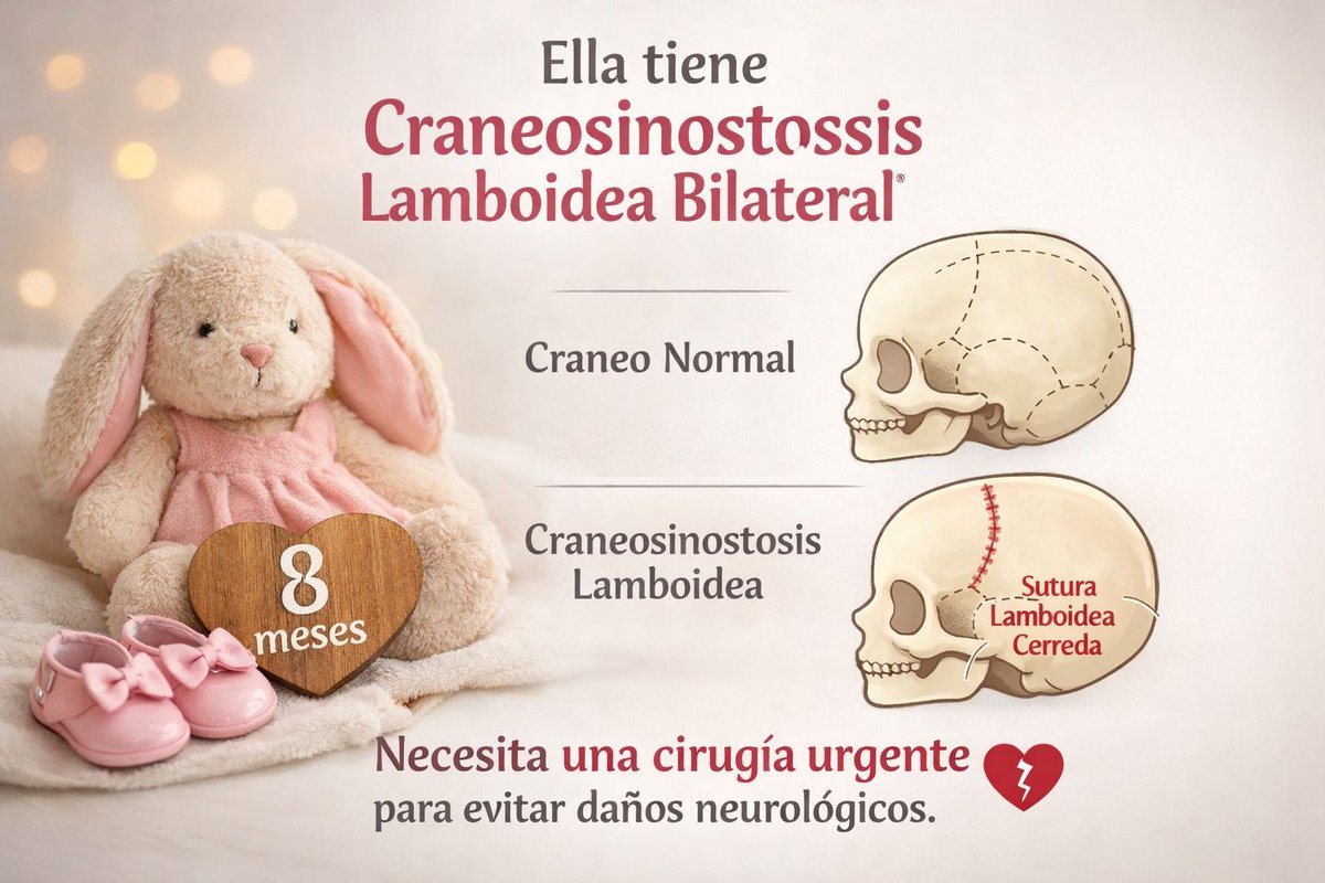 No dejaré de gritar a los 4 vientos.!!
Sofia necesita operación antes de los 12 meses.
El craneo de esta cerrando 🆘🆘
Por favor difusión máxima para que puedan operar a la pequeña Sofía.
🙌🏼🙏🏼