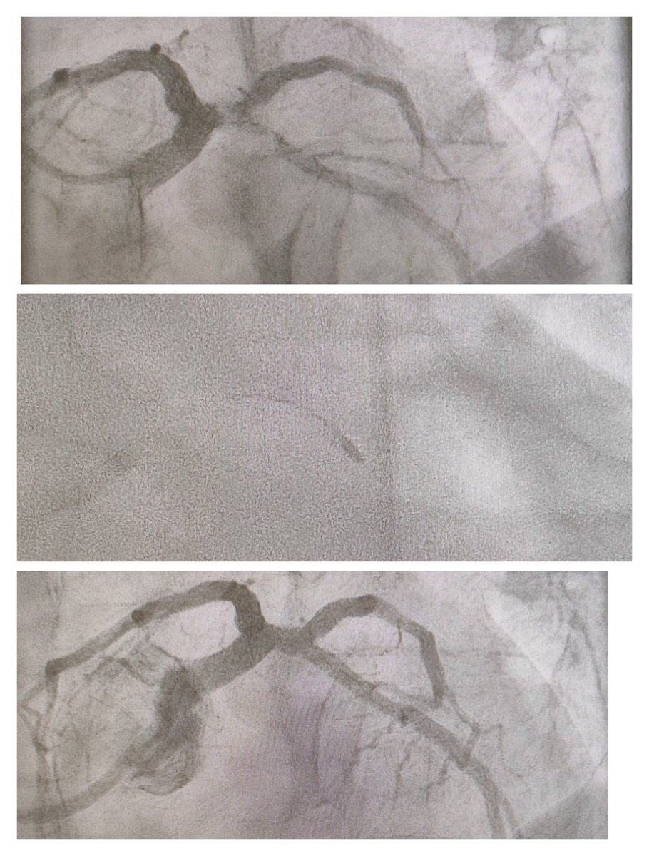 wisevision2010's tweet image. #Rotablation#chippci  ⁦@SRIHER_Official⁩ ⁦@SRMC_official⁩ ⁦⁦@BSCCardiology⁩ ⁦ ⁦@PCRonline⁩ ⁦@ACCinTouch⁩ ⁦@SCAI⁩
@AnkurGuptaMD @TCTMD 
@ESC_Journals @EAPCIPresident 
@evandrofilhobr #rotapro #bifurkation @ESC_Journals