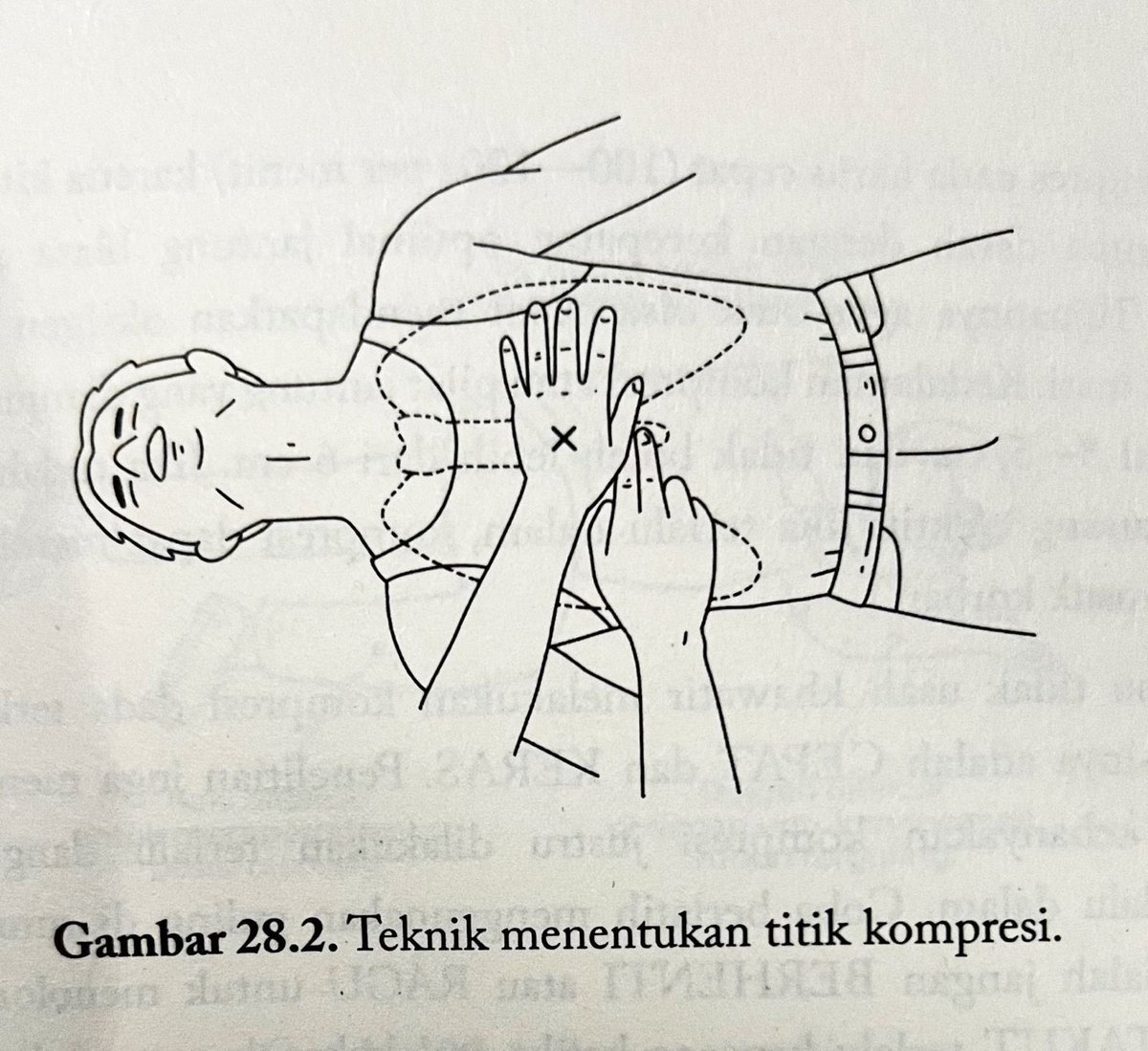 afrkml's tweet image. #SEBARIN
Banyak yg ga ngerti bahwa:
Henti jantung ≠ Serangan jantung.

CPR dilakukan hanya utk henti jantung!

Cara mengenali henti jantung utk penolong awam gk terlatih:
1. Cek respons orangnya dulu, pastiin dia gak sadar.
2. Panggil bantuan secepetnya.
3. Pastikan henti…