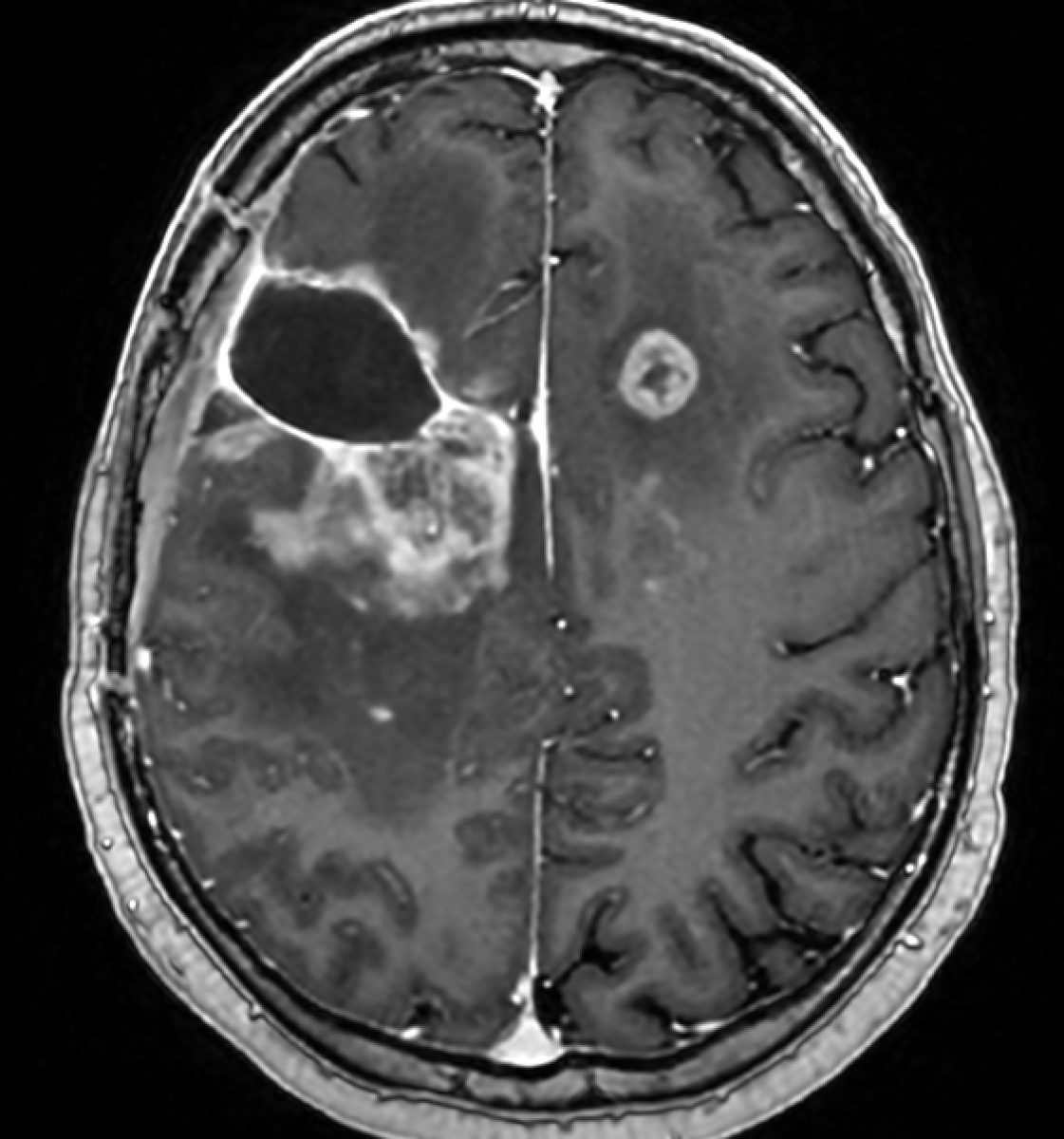jjgarnham's tweet photo. 🩻This is a post‑debulking glioblastoma, IDH‑wildtype. After two doses of Avastin (bevacizumab), there appears to be dramatic regression of tumour on the post‑contrast images, but the ADC map tells a different story: it shows an expanding front of restricted diffusion, suggestive of hypercellular tumour. How do we explain this?

💡This is likely to be pseudoresponse. Avastin stabilises the blood–brain barrier, inducing a rapid reduction in contrast enhancement and vasogenic oedema. Although Avastin can improve progression‑free survival, it has not been shown to improve overall survival in glioblastoma.

💡Avastin‑related coagulative necrosis can also manifest as regions of low ADC, so while the expanding rim of restricted diffusion is concerning for tumour progression, follow‑up is needed to confirm whether it enlarges (supporting progression) or remains stable (more compatible with coagulative necrosis).