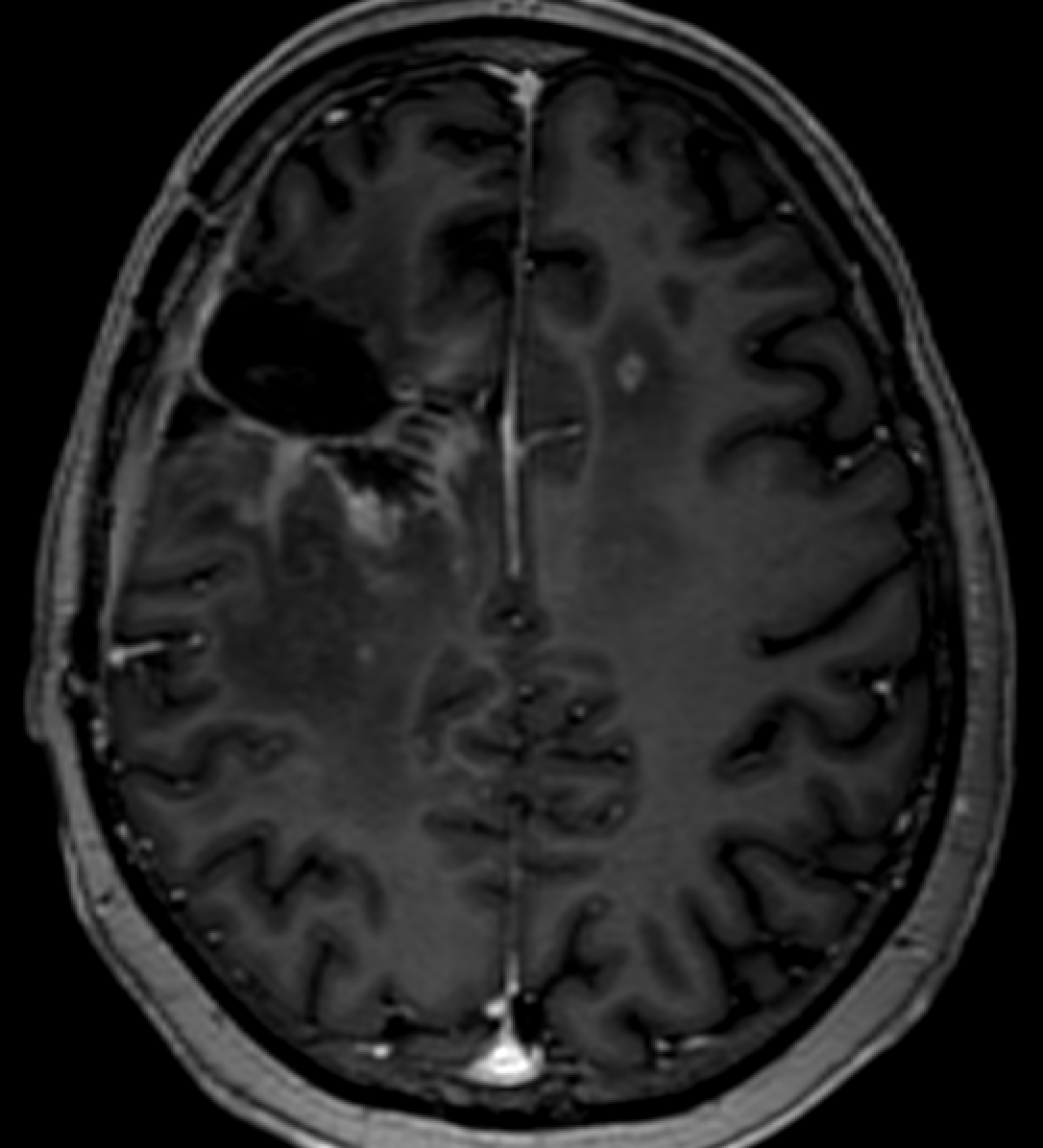 jjgarnham's tweet photo. 🩻This is a post‑debulking glioblastoma, IDH‑wildtype. After two doses of Avastin (bevacizumab), there appears to be dramatic regression of tumour on the post‑contrast images, but the ADC map tells a different story: it shows an expanding front of restricted diffusion, suggestive of hypercellular tumour. How do we explain this?

💡This is likely to be pseudoresponse. Avastin stabilises the blood–brain barrier, inducing a rapid reduction in contrast enhancement and vasogenic oedema. Although Avastin can improve progression‑free survival, it has not been shown to improve overall survival in glioblastoma.

💡Avastin‑related coagulative necrosis can also manifest as regions of low ADC, so while the expanding rim of restricted diffusion is concerning for tumour progression, follow‑up is needed to confirm whether it enlarges (supporting progression) or remains stable (more compatible with coagulative necrosis).