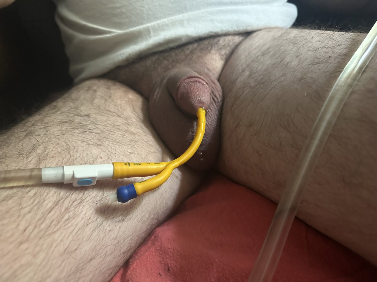 lockedinnd's tweet photo. Pur in a 22 on Thursday but had to pull that one Friday afternoon because the spasms were terrible. Got home last night after a couple drinks and a shower and put in a 24, so far so good! #cathplay #foleycatheterplay https://t.co/aJEOfokCEx