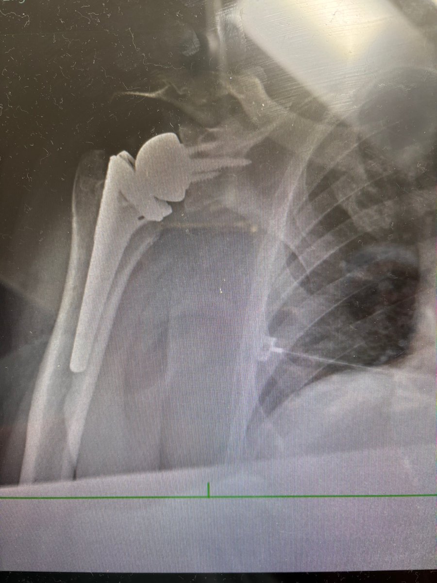 DrRobertKlapper's tweet image. WEEKENDWARRIOR SHOW. MeasureTwice Cut Once! My favorite Shoulder Surgery! #Stone&amp;amp;Bone