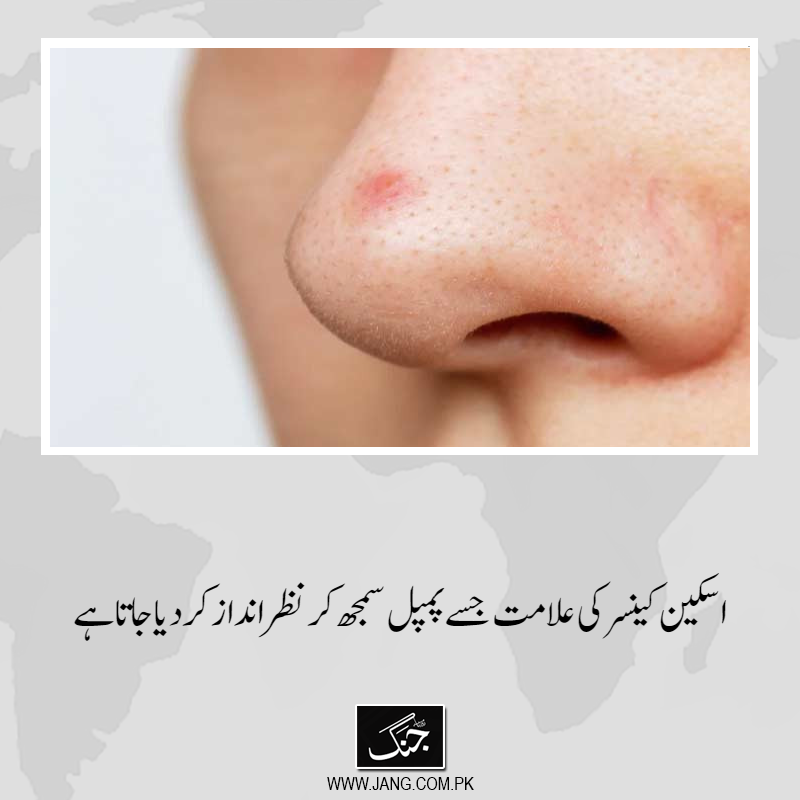 jang_akhbar's tweet photo. جو اکثر ایک عام دانا یا معمولی جلدی مسئلہ دکھائی دیتا ہے، جسے لوگ اکثر نظر انداز کردیتے ہیں، ماہر امراض اسکین
تفصیلات جانیے:https://t.co/Yy95uD2dFh
#DailyJang #Skin #BasalCell #Healthreport https://t.co/GNZfnvIDxl