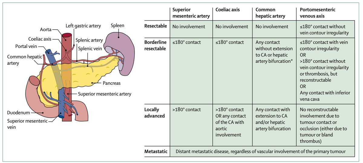 AchintyaSinghMD's tweet image. Pancreas cancer: thelancet.com/journals/lance…

➡️ Number needed to screen: 135
➡️Tumor has a desmoplastic stroma leading to ⬆️ intra-tumoral pressure, ⬇️ chemo penetration
➡️56% have mets @ diagnosis
➡️ Annual screening is not failure proof, most tumors @ 11 months from index screen