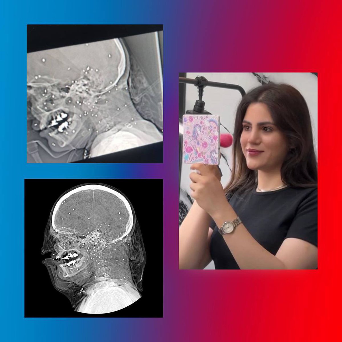 Breaking | Sagar Etemadi, 22, from the city of Farsan (Chaharmahal and Bakhtiari), was shot in the head with a shotgun during the protests. She was taken to hospital in critical condition and has passed away moments ago. She joins the caravan of the martyrs of freedom.