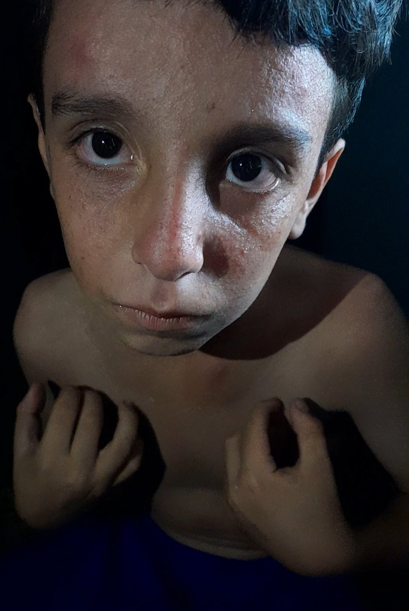 RozeatG's tweet image. 💔Adam is suffering from a contagious rash due to the pollution dirt and dust in his environment His condition is worsening day by dayand I can't afford treatment or cleaning supplies Please help me so I can treat him🙏

 Even a dot would be appreciated

chuffed.org/project/137260…