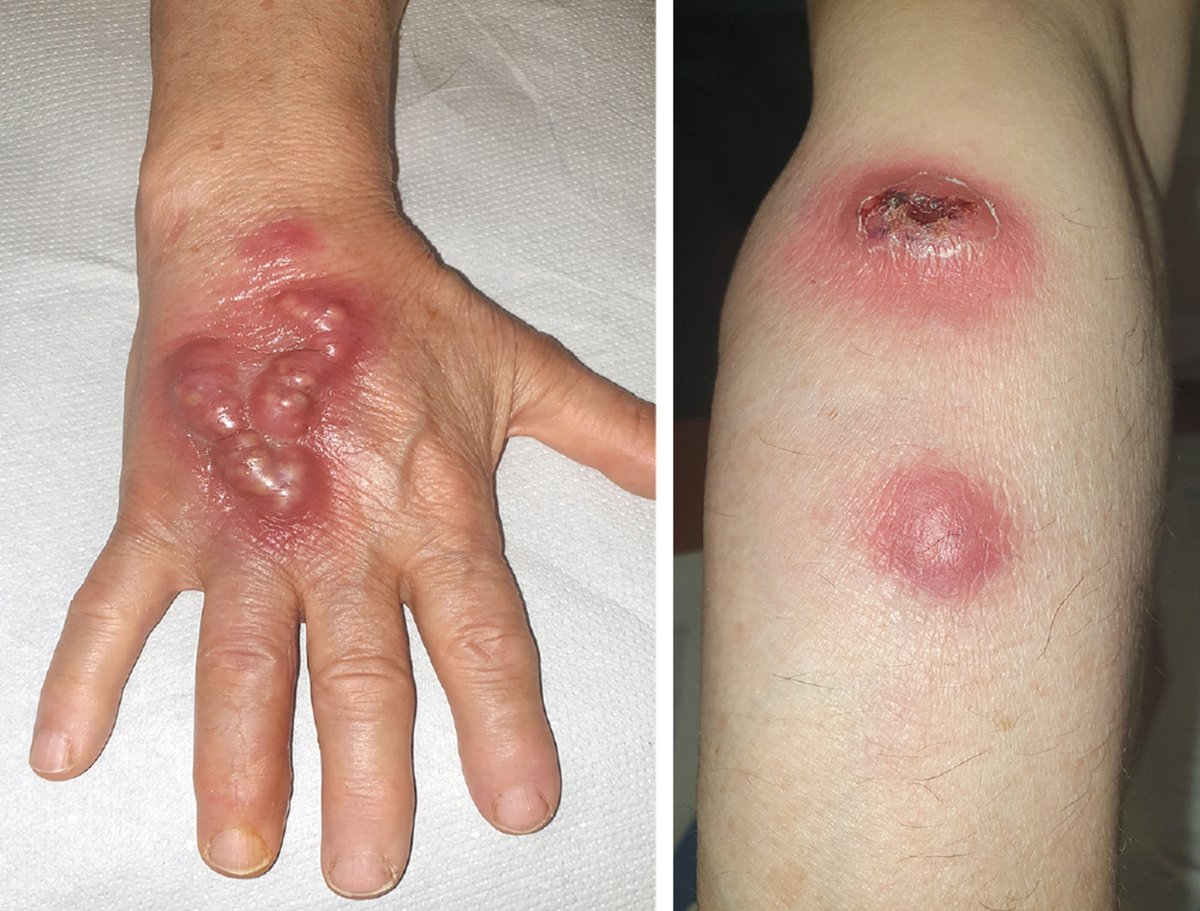 MTD_MED's tweet image. A 75-year-old woman presents with a 10-day history of painful lesions on the right hand and forearm. 👇

Aspiration of a lesion shows:
• Filamentous
• Gram-positive
• Acid-fast branching rods

👉 What's the most likely diagnosis?

Credit: NEJM 
#MedX #MedTwitter #MedEd…