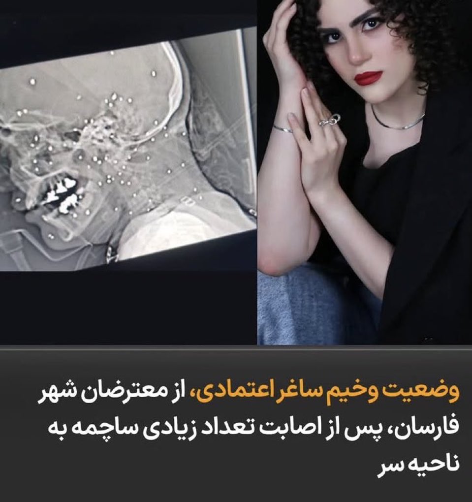 SanaELedene's tweet photo. Saghar Etemadi from Farsan was shot with rubber pellets (ساچمه). Her condition is currently reported as critical. https://t.co/2lziiZfmGy