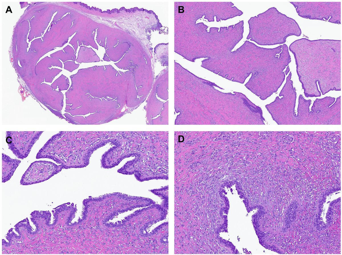 IJSPjournal's tweet image. Not something you see everyday 👇🏼🧐
Male patient presenting with an anal mass.
🔬What would be your diagnosis?
"Leaf" all things aside and check out this case report @ IJSP for the ✅answer:
doi.org/10.1177/106689…

#PathTwitter #GIPath