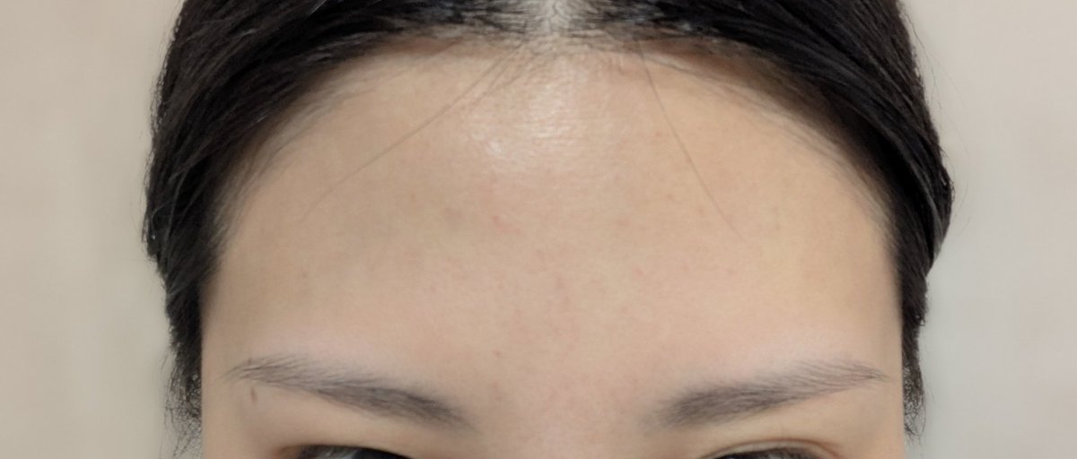 ジュベルックから約24時間後の経過📷️
光で飛んでしまった部分があるけれど、全体的にまばらに内出血あり。おでこに若干のボコつきあり。
鼻の毛穴がとても深いから、少しでも埋まってほしい😂💦