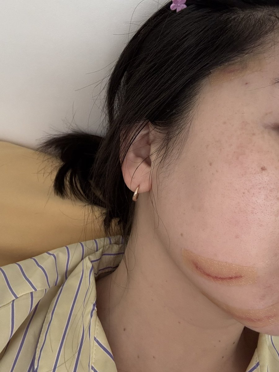 자다가 봉변 .. 뭐에 놀라서 이런건지 .... 😭