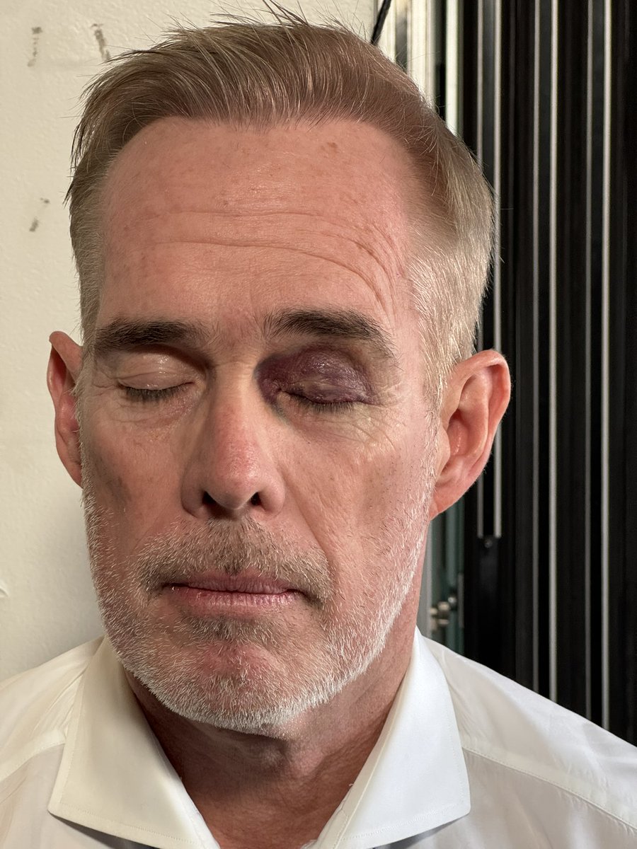 Buck's tweet image. Not all heroes wear capes, but some bring them to work.  Our makeup artiste, the great Kathleen Vybihal hid this from high def cameras tonight. Nothing like a knee to the eye while breaking up a fight between 7 year old twins 48 hours before a big game!!!  He got me!!