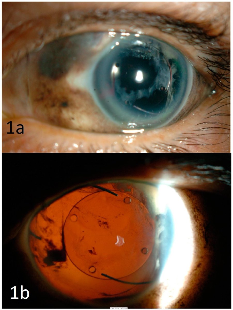 There are parts of you that are strangers to the rest of you,,, They live like exiles within your own body. Not because they are unimportant, but because they are too precious to be misunderstood.  Your eyes is one of those part that have this immune privilege. This means your