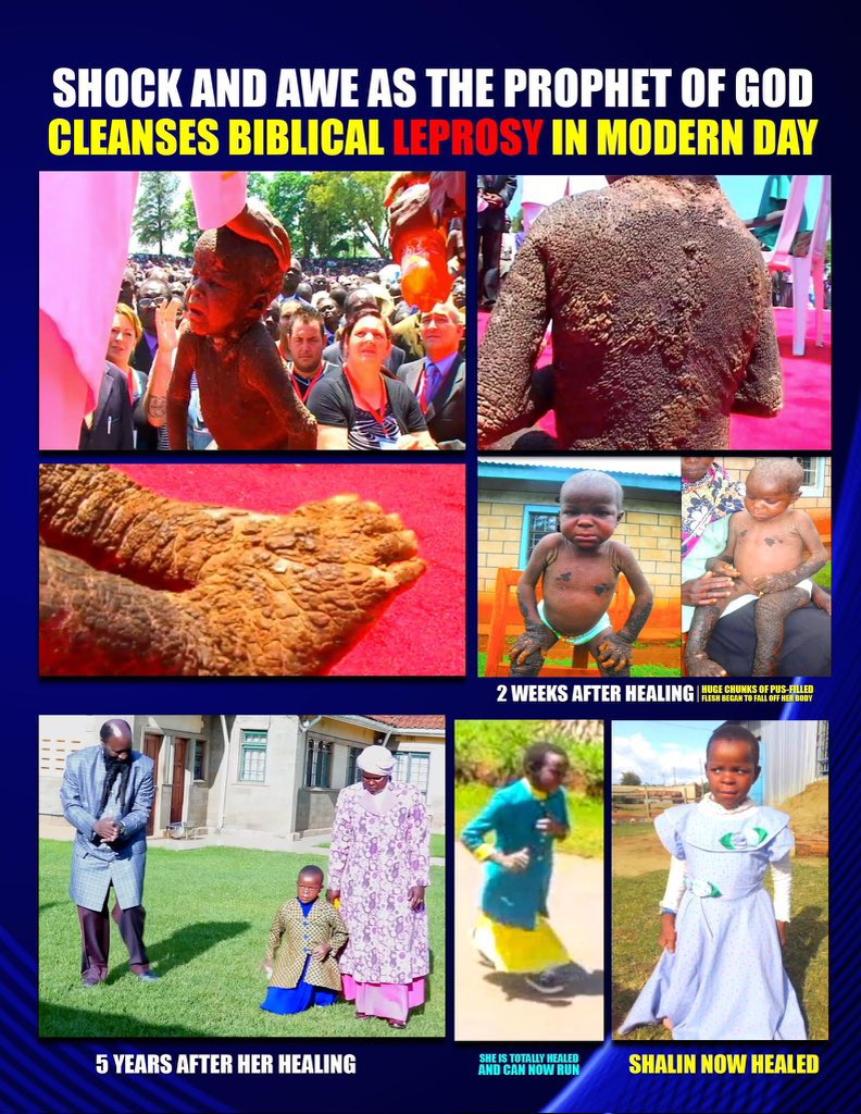 There is no injection, no pill, no medical procedure that can heal leprosy!
But JESUS did it!

#ScienceBows because there is no other way around it.