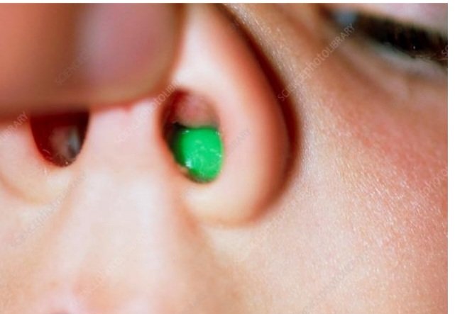 Plus de peur que de mal. 
Corps étranger enclavé dans les narines de l'enfant : c'est pas toujours simple . CAT  se rendre à l'hôpital pour une extraction au risque de l'enfoncer davantage.
Le dernier cas discuté était un caillou introduit dans la narine. 
Extraction faite en