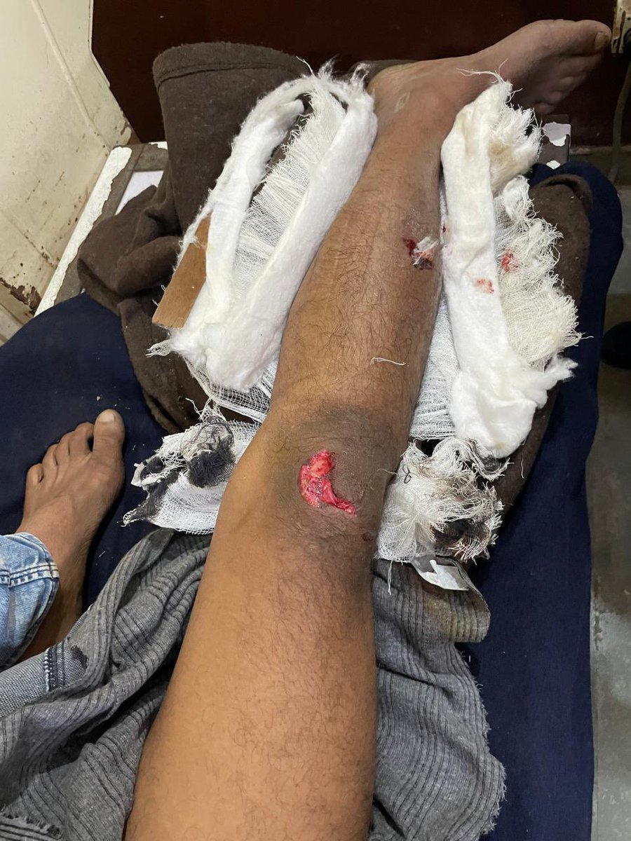 SmartSasni's tweet photo. बीजेपी शासन काल में दलित का उत्पीड़नहाथरस जिला के सिकन्दराराऊ थाने का मामला दबंगों द्वारा दलित का मेजर एक्सीडेंट करने के बाद भी अभी तक सिकन्दराराऊ कोतवाली द्वारा एफ आई आर दर्ज नहीं की गई अपोज़िट पार्टी का थाने में दबदबा बताया जा रहा है @Uppolice @dgpup @dm_hathras @hathraspolice https://t.co/ZW9AQSAB6Y