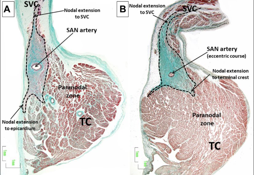 Dr. José Ángel Cabrera (@jacabreracardio) on Twitter photo 👩🎓👨🎓The Sinoatrial Node part I sciencedirect.com/science/articl… <a href="/JACCJournals/">JACC Journals</a>
The variable architecture of nodal tissue in relation to the 🔹endo/mio/epicardium 🔹nodal extensions & paranodal tissue 🔹SN artery🔹innervation …<a href="/DrAJRestrepo/">Alejandro Jimenez Restrepo</a> <a href="/MRazminia/">Mansour Razminia</a> <a href="/DamianSanc1955/">Damian Sanchez Quintana</a> <a href="/cardiac_anatomy/">Cardiac Anatomy</a> 👩🎓👨🎓The Sinoatrial Node part I sciencedirect.com/science/articl… <a href="/JACCJournals/">JACC Journals</a>
The variable architecture of nodal tissue in relation to the 🔹endo/mio/epicardium 🔹nodal extensions & paranodal tissue 🔹SN artery🔹innervation …<a href="/DrAJRestrepo/">Alejandro Jimenez Restrepo</a> <a href="/MRazminia/">Mansour Razminia</a> <a href="/DamianSanc1955/">Damian Sanchez Quintana</a> <a href="/cardiac_anatomy/">Cardiac Anatomy</a>