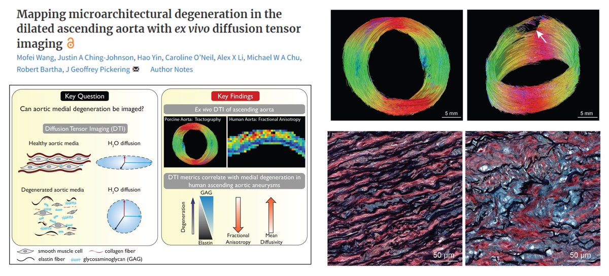 HaoYin20's tweet image. Happy to report our #EHJOpen paper @ehjopen
Use #DiffusionTensorImaging (#MRI quantifying water movement) to map aortic medial degeneration in human #ThoracicAorticAneurysm 😎
From Mofei Wang (X-less) & Justin Ching-Johnson @ChingJohnson at Pickering lab @SchulichMedDent…