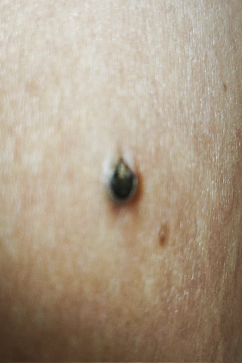For the past two years, I've had unusual moles on my abdomen, 
I don't know what it is, but some people say that the perpetrators implant chips in abdomen.

#TargetedIndividuals
#思考盗聴 #テクノロジー犯罪
#Gangstalking
#mindcontrol
#V2K
#v2k
#Electronictorture
