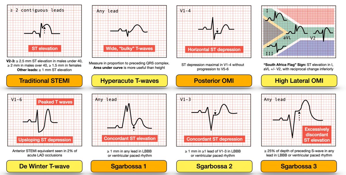 Killer ECGs , good to know :