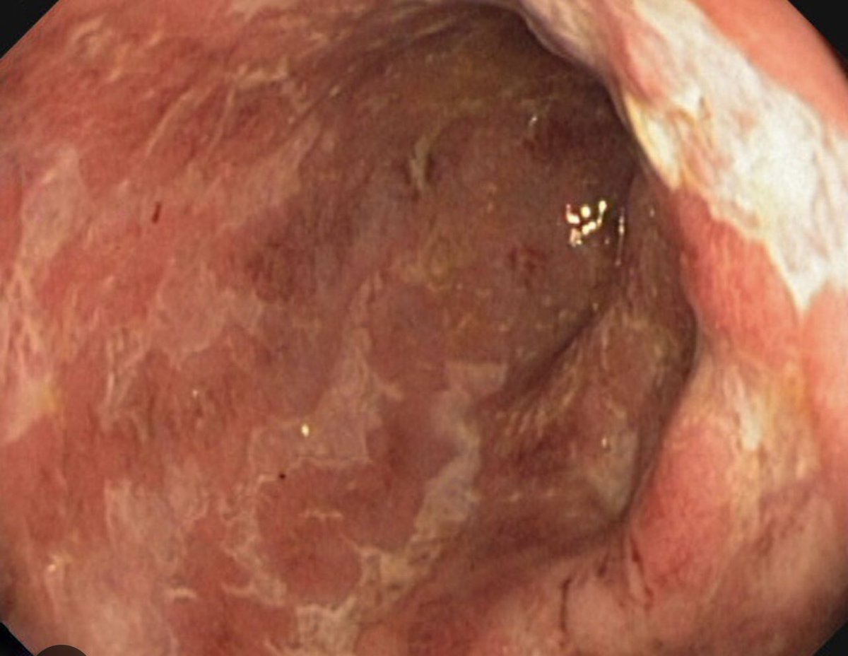 ScottRSteeleMD's tweet photo. #quickcase. A mid-30s patient with #crohns has been on multiple biologics and noted to have a tight proximal sigmoid stricture. Dilation not helped. Also with anal stricture requiring multiple dilations. Remainder of colon looks good. How do you proceed? https://t.co/9Ba53wKNDj