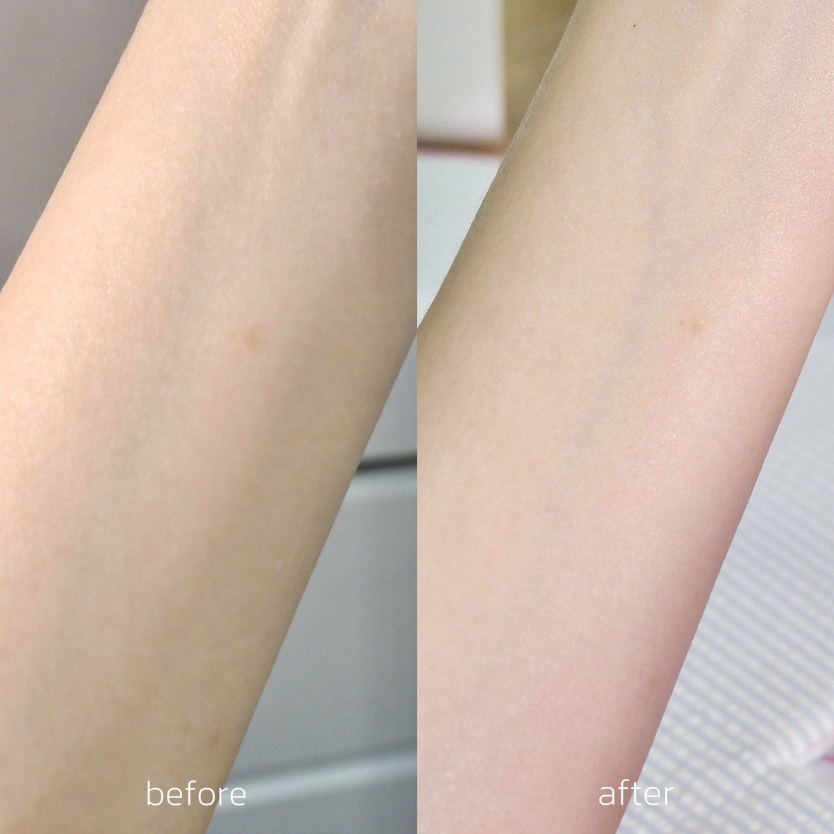 smilexjynx's tweet image. อยากให้ลองโลชั่นของยูเดอร์มา สูตรผิวใสเข้มข้น หลอดชมพูอะ คนผิว sensitive หมองคล้ำง่ายแบบเรา คือต้องมี🥺 คือช่วยผลัดเซลล์ผิวอ่อน ๆ ปรับผิวกระจ่างใสและสม่ำเสมอขึ้น ลดผิวหมอง ซึมง่ายมาก! ทาแล้วซึมเลย ผิวไม่เหนียว 10/10! ผ่านการทดสอบโดยแพทย์ผู้เชี่ยวชาญด้านผิวหนังด้วย…