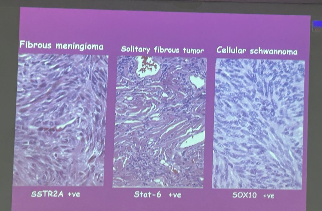 pathridle_susan's tweet image. Neuropathology  #Apcon2023
#pathtwitter #pathology #pathboards #neuropath #PathX