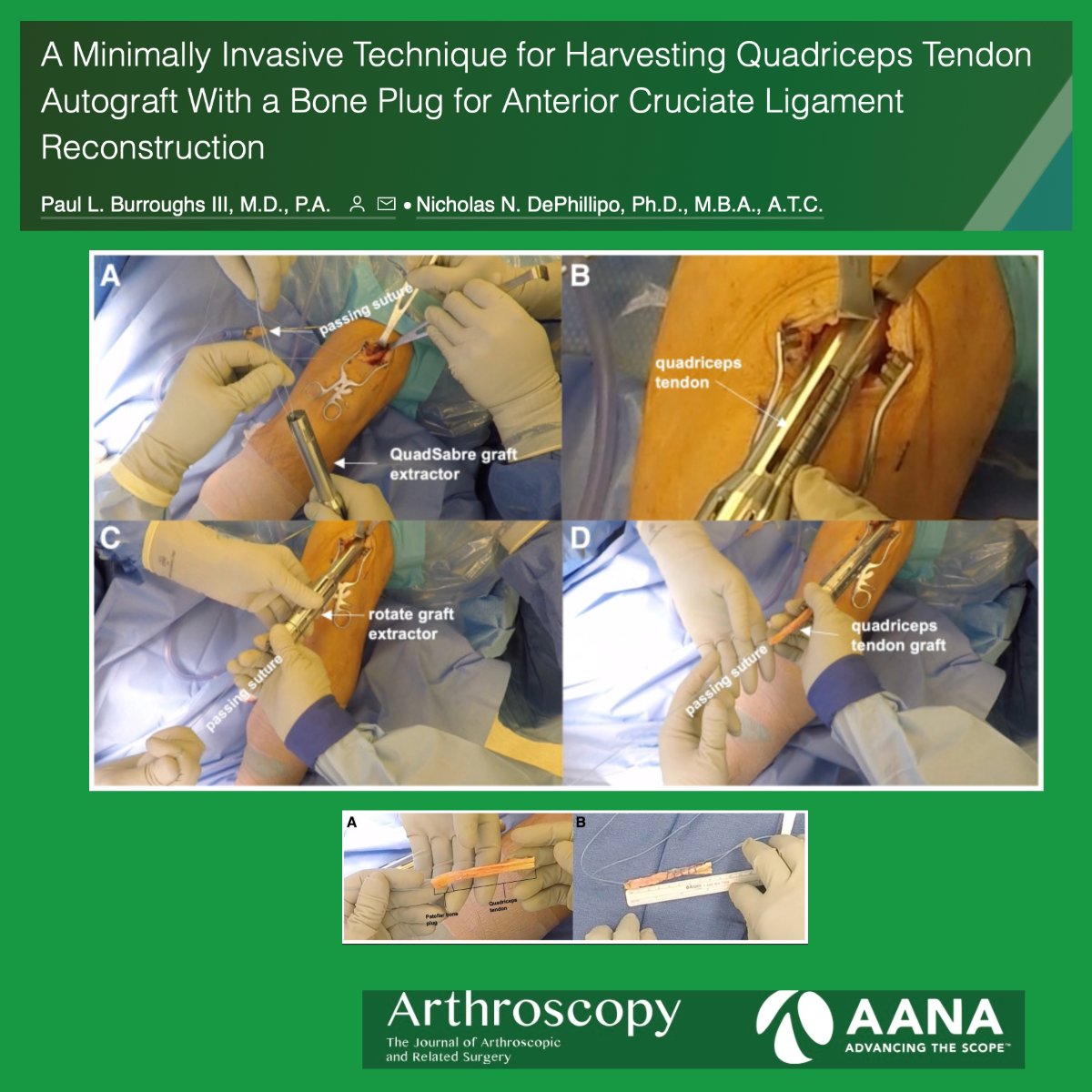 A Minimally Invasive Technique for Harvesting Quadriceps Tendon Autograft With a Bone Plug for Anterior Cruciate Ligament Reconstruction @Ndephillipo arthroscopytechniques.org/article/S2212-…