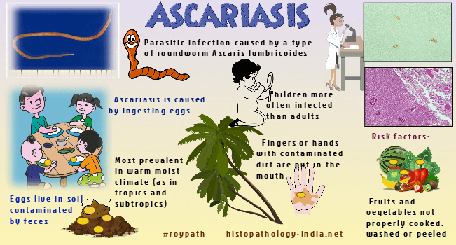 schowardjd's tweet photo. @drkeithsiau Ascariasis ( Ascaris lumbricoides )

[image source: @DrSampyRoy, #RoyPath, https://t.co/lONei2zFOn] https://t.co/0KTPXKpirj