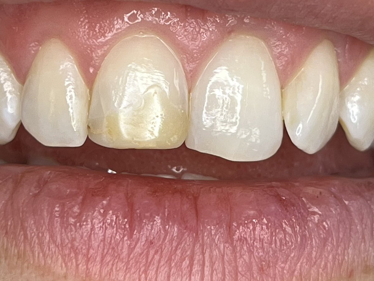 SurgeryHouse's tweet photo. Want to improve your smile? This is Renamel…. Contact us https://t.co/Yg1fBtzodp
