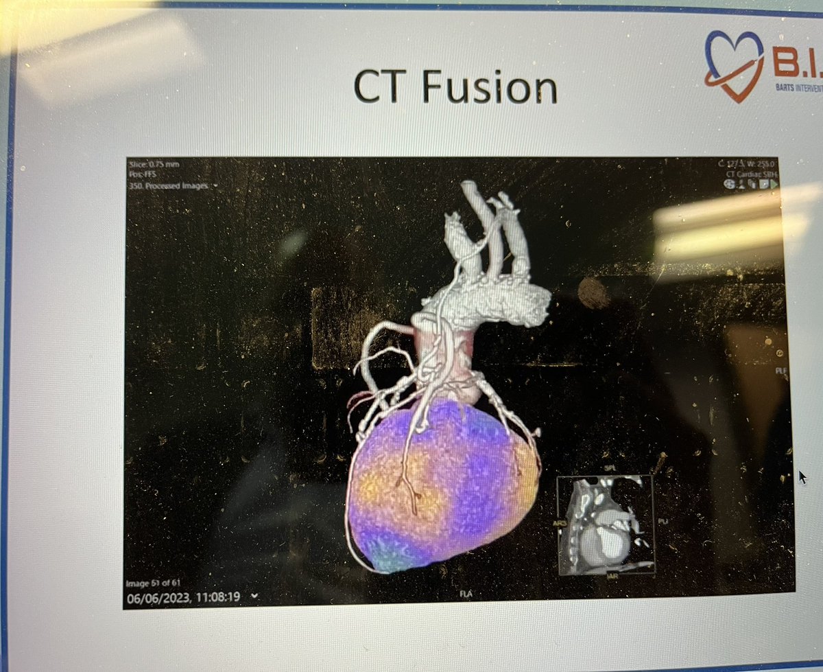 LondonCardiacCT (@londoncardiacct) on Twitter photo Cool PET/CT fusion in a grafts case pre-planning native vessel re-intervention <a href="/BartsIntervGrp/">Barts Interventional Group (B.I.G.)</a> cardiac imaging course Cool PET/CT fusion in a grafts case pre-planning native vessel re-intervention <a href="/BartsIntervGrp/">Barts Interventional Group (B.I.G.)</a> cardiac imaging course