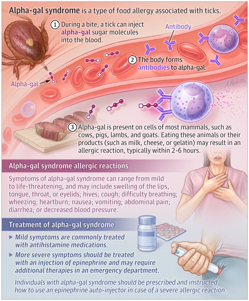 Alpha-gal syndrome is a type of food allergy to mammalian (red) meat products. This JAMA Patient Page discusses alpha-gal syndrome and its symptoms, diagnosis, treatment, and prevention. ja.ma/3Rh1tBC