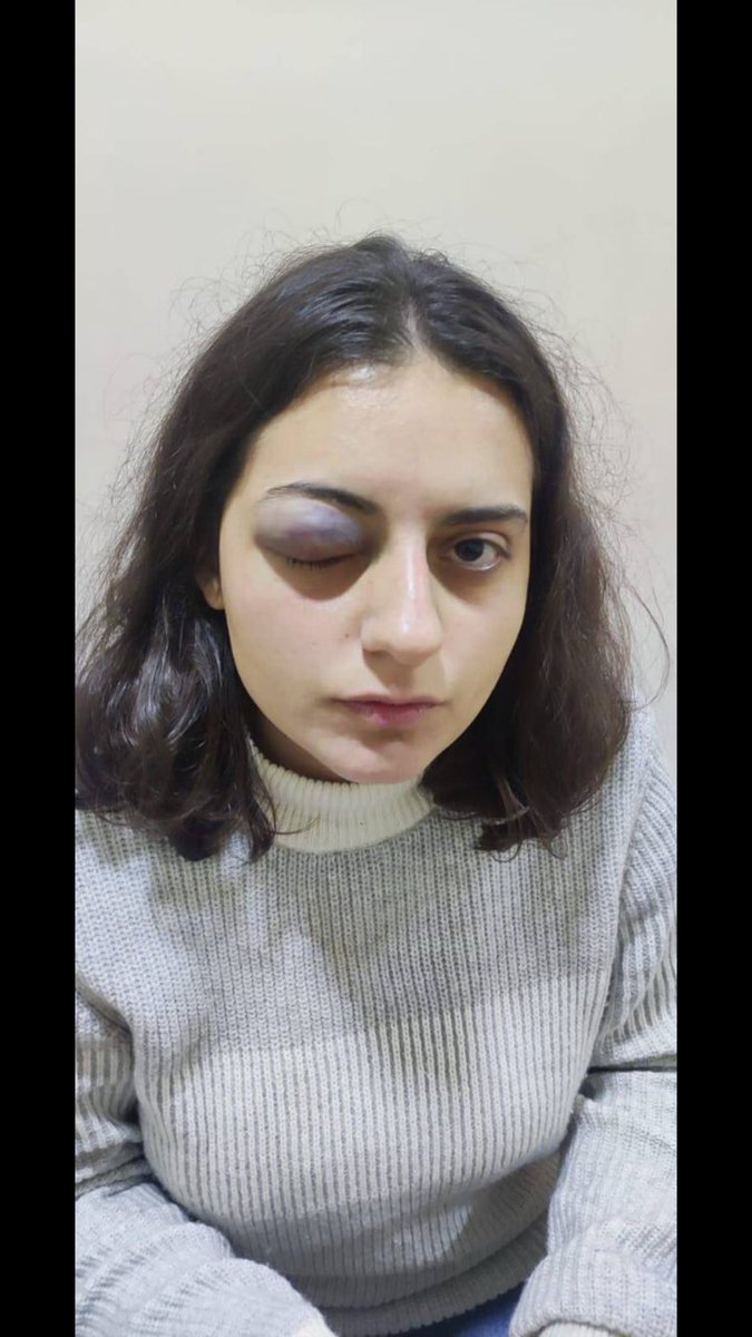 Ew êrîşên kirêj ser berdevka meclîsa ciwan a Hedep ê Edanur İbrahimoğlu kevimîye em kebûl nakin û carek din dibêjin hesabê ev hemû êrîşin kirêj tê bê pirsîn.
#bijiberxwedanaciwana