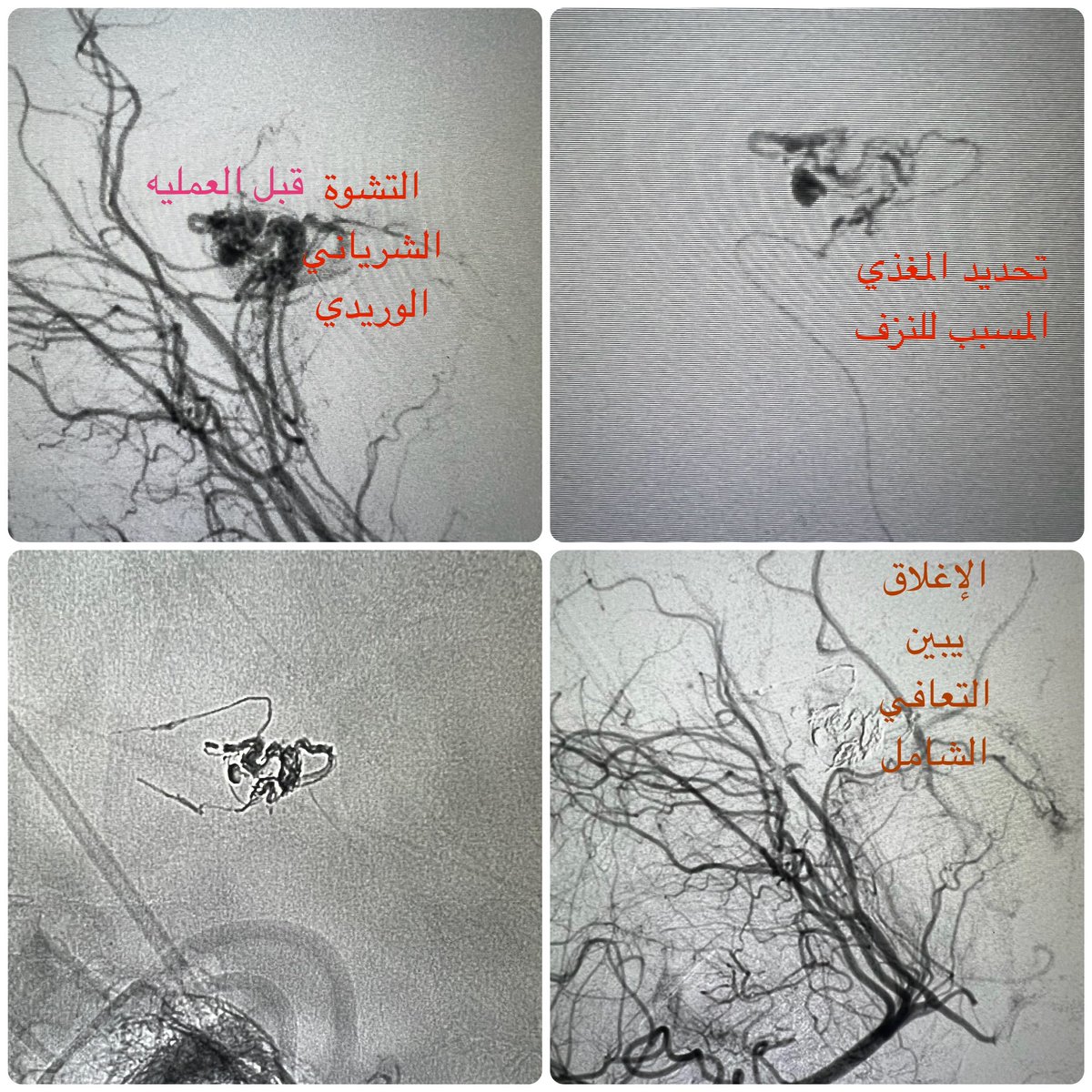 DrSultanQahtani's tweet photo. نزف التشوهات الشريانية-الوريدية الدماغية لدى الاطفال تعتبر تحديا للفريق المعالج،،، طفله عمرها سبع سنوات عانت فجأة من نزف🩸دماغي حاد 🧠 أسقطها بغيبوبه تامه.. تم معالجتها عن طريق القسطرة الدماغية التداخليةالدقيقة،، وبفضل الله ثم بجهود الفريق المعالج تماثلت للشفاء تماما✅@pairsmedia @PairsNeuro @PairsWeb @sirs_ksa @mena_sino
