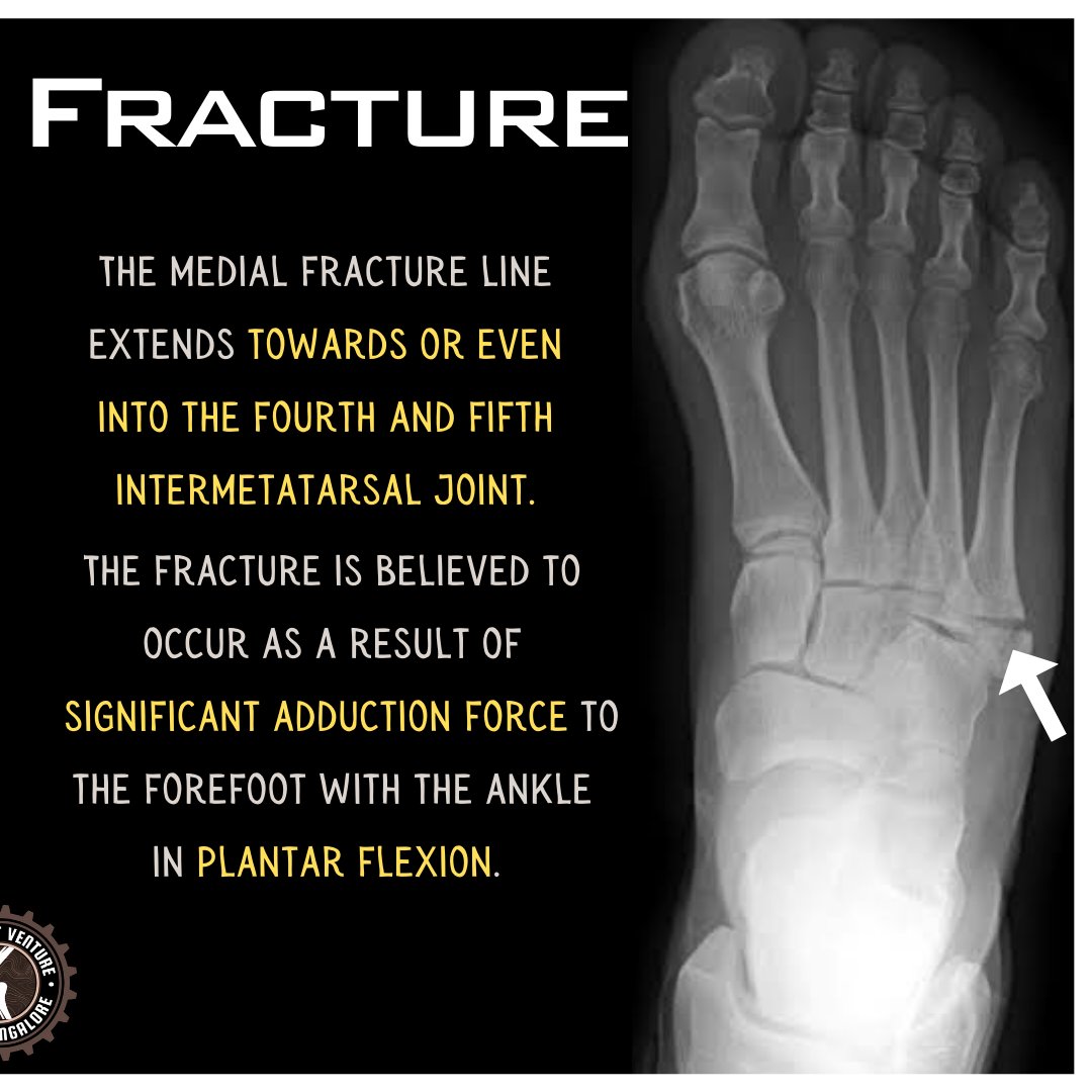 tjv_kmcmlr's tweet photo. Introducing Fracture Fridays: A series where we discuss the X-ray findings of various fractures🦴

Here's our first one on 'Jones and Pseudojones Fracture'

Stay tuned for more✨️

@KMC_Mangalore @KmcMangOrtho https://t.co/oTvAxb6MsT