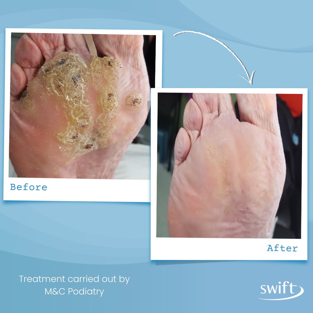 This patient was 72 years old and had been struggling with painful plantar warts for 54 years. After 10 Swift treatments at Essex Podiatry, she had full clearance of her plantar warts.

#SwiftTreatment #wartsandall #FootCare #VerrucaRemoval #plantarwarttreatment #treatwithswift