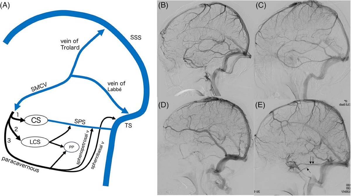 Functional Cerebral Venous Anatomy from the Viewpoint of Venous Collaterals Part I, Supratentorial Superficial and Deep Venous System | Stroke: Vascular and Interventional Neurology ahajournals.org/doi/full/10.11… @StrokeAHA_ASA @svinsociety @SVINJournal