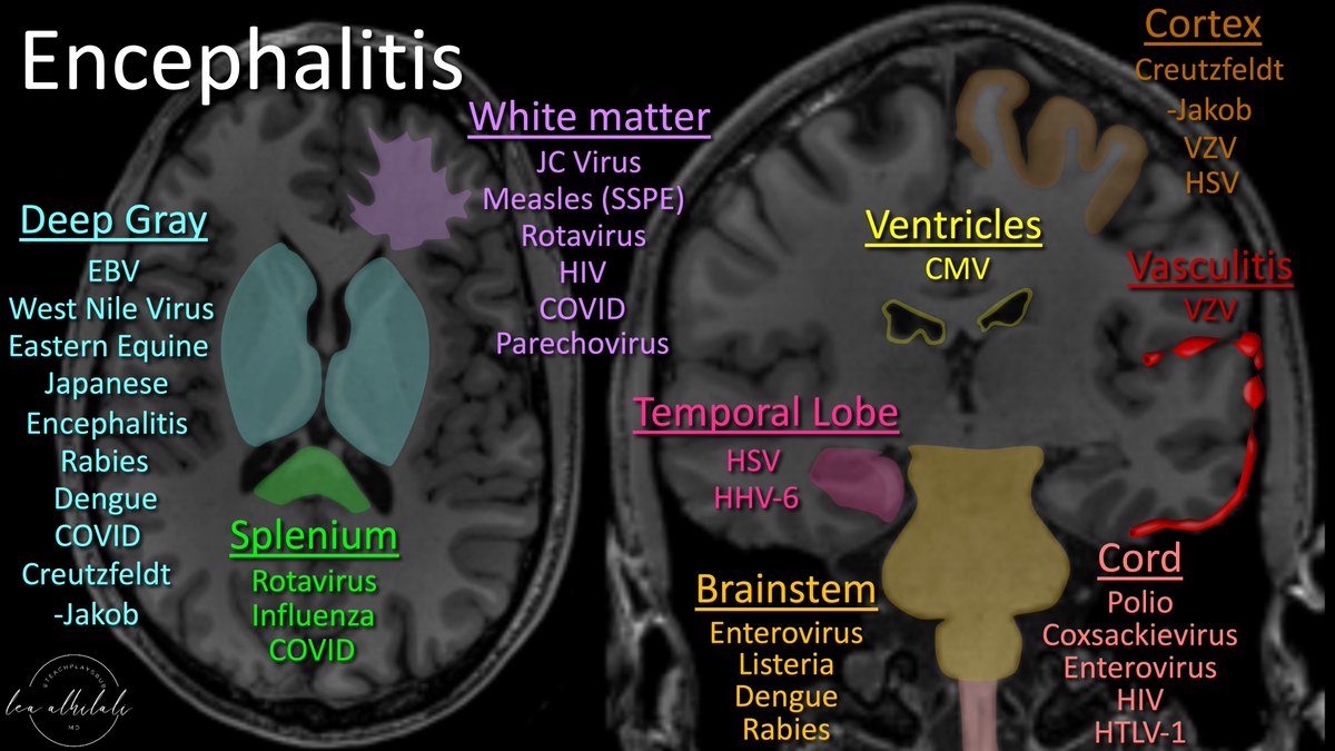 Knowledge is contagious!

Infectious encephalitis is a difficult diagnosis, but patterns on MRI can suggest an etiology.

Most know herpes &amp; the temporal lobe

Do YOU know any more?

Here’s a figure to help you remember the most “common” encephalitis patterns for different