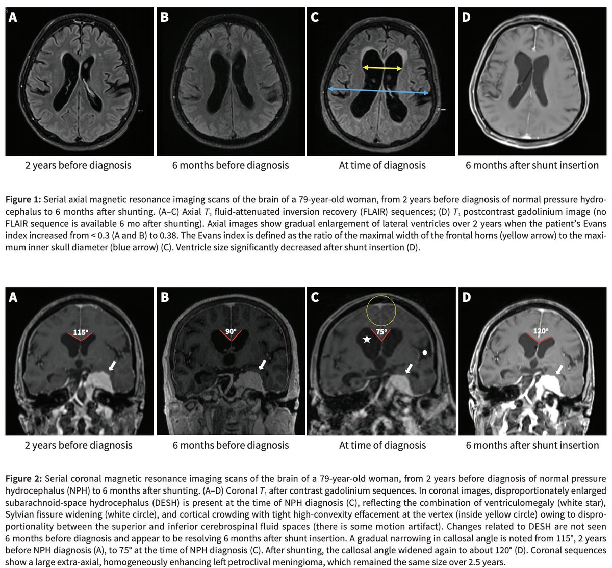 Is normal pressure hydrocephalus (NPH) over-diagnosed? YES. When appropriately diagnosed and treated can some symptoms improve w/ shunting. YES. Nice article by Akter and colleagues to help clinicians on their journey to sort this out.
Key points:
- NPH: think ventriculomegaly in